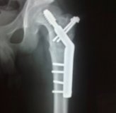 Femoral Ost1